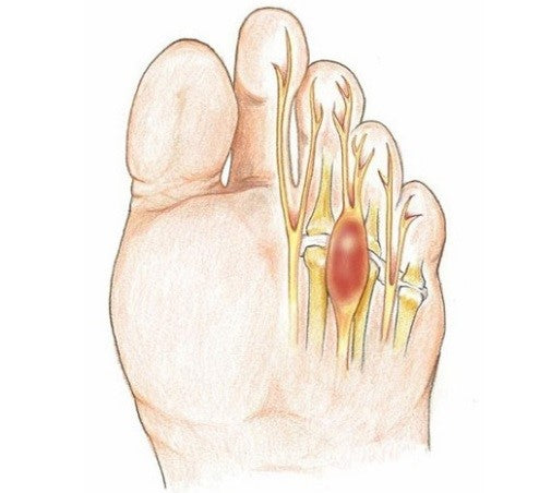 Neuroma di Morton: Plantare e Trattamento